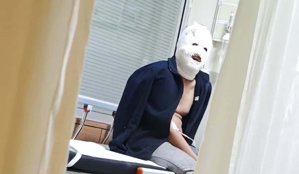 İnegöl'de Sobayı Yakarken Yüzünü Yaktı