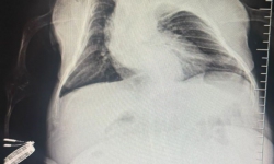 İnegöl'de karın ağrısıyla doktora gitti, tam 3 kilo kist çıktı