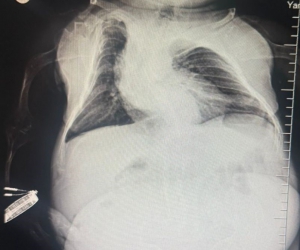 İnegöl'de karın ağrısıyla doktora gitti, tam 3 kilo kist çıktı